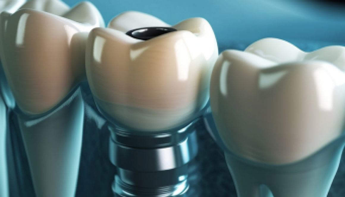 benefits of dental implants