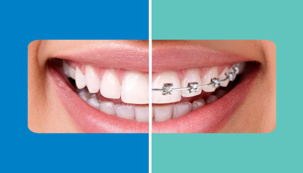 Clear Aligners