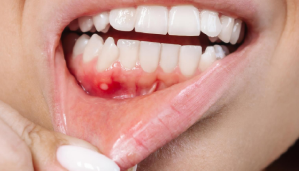 Gum Recession