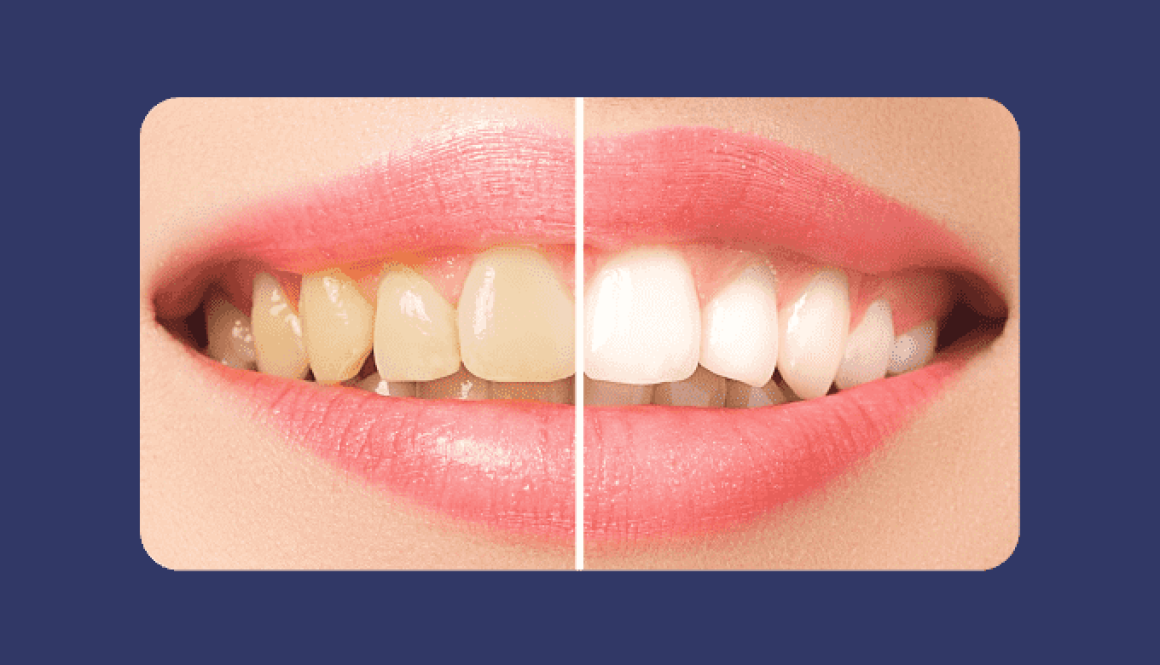 Why Clear Aligners Are Better than Traditional Braces (1)