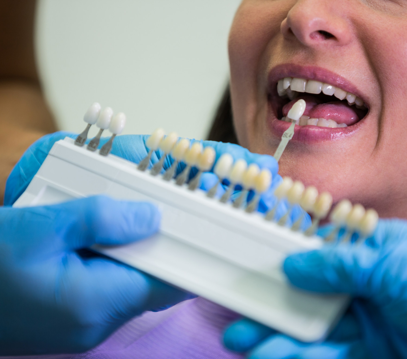 Everything You Need to Know About Porcelain Veneers for a Stunning Smile