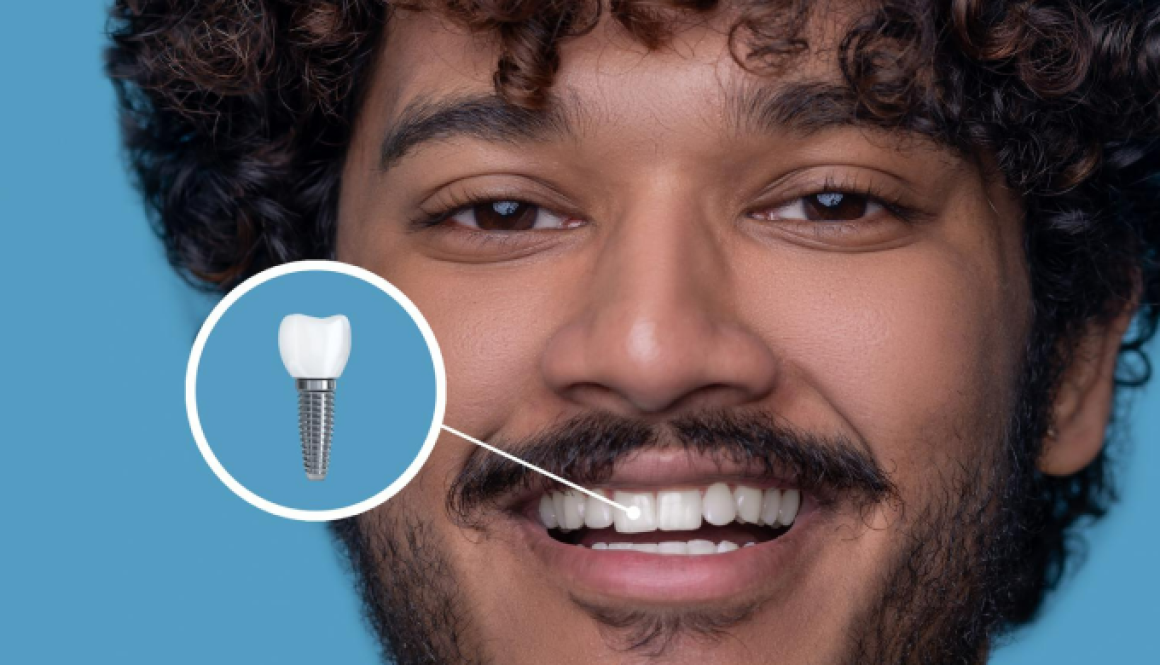 How Long Do Dental Implants Last? Tips for a Lifetime of Smiles?