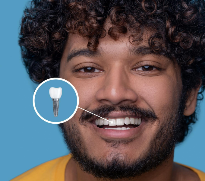 How Long Do Dental Implants Last? Tips for a Lifetime of Smiles?
